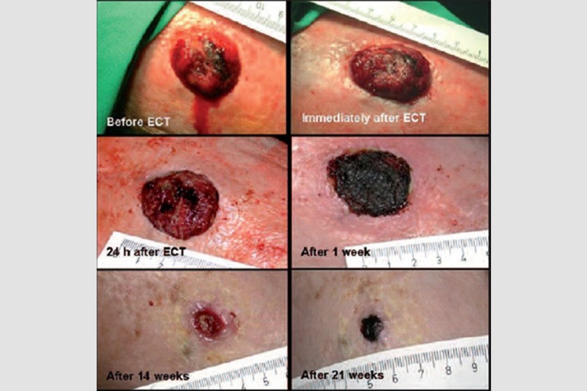 Electrochemotherapy in the ImunoMedica clinic