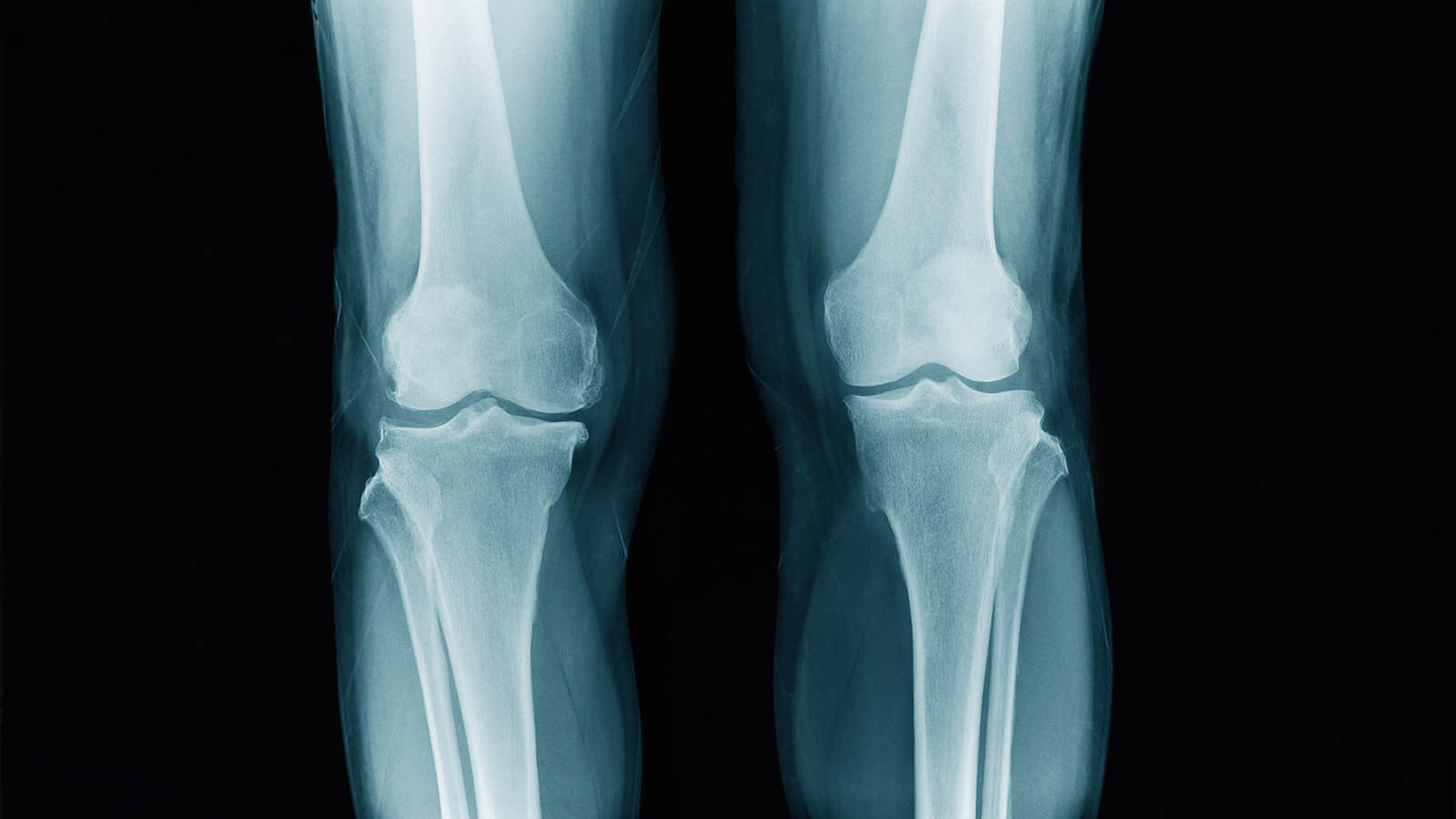 Laser Intra-articular